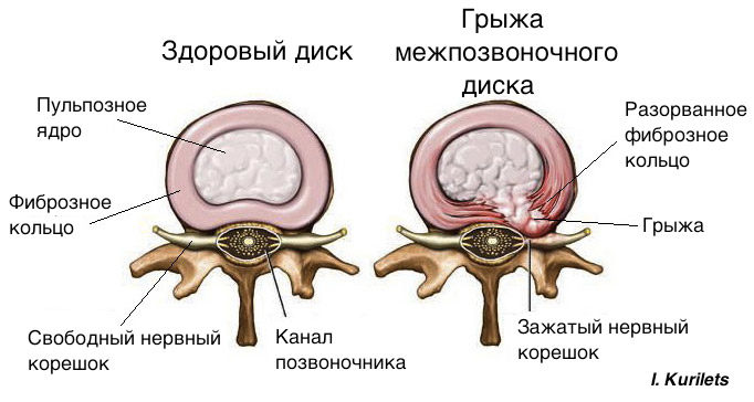 Беспокоит грыжа диска: вместо операции попробуй это! 01_ru