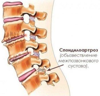 Спондилез - спондилартроз