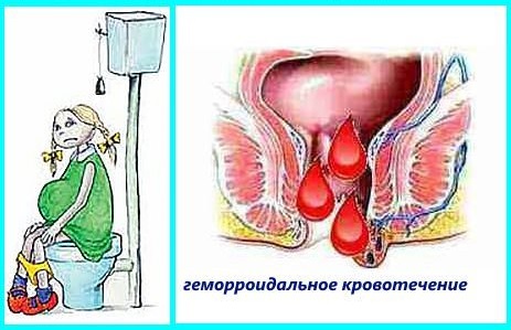 Что делать, если кровоточит геморрой: экстренные меры