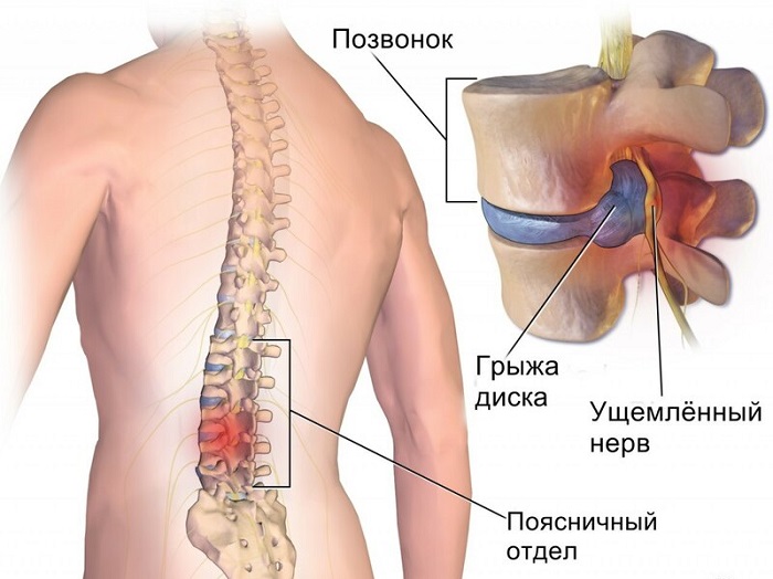 Как вылечить межпозвоночную грыжу без скальпеля: операция больше не нужна!